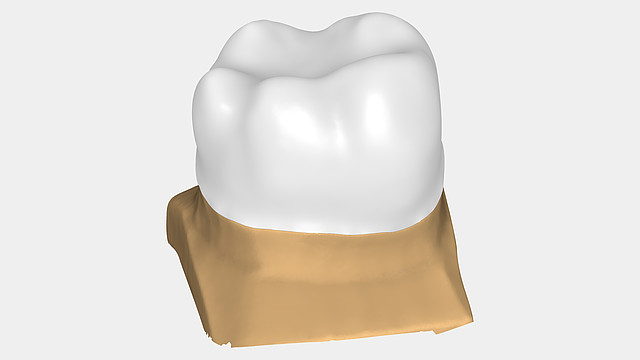 Anatomic/simple copings