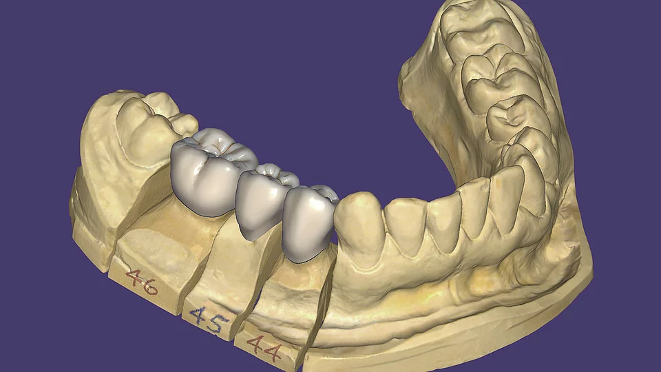 exocad DentalCAD