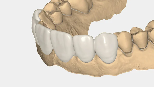 Clip-on smiles