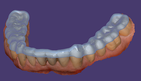 Bite Splint Module