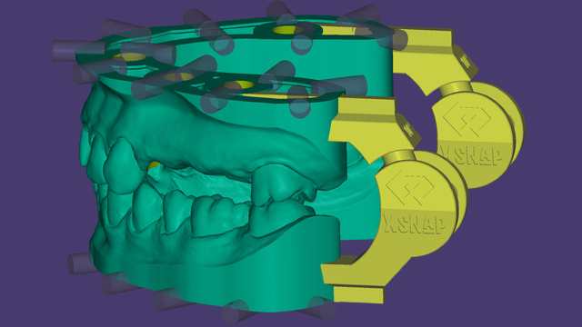 First dental models with printable articulator