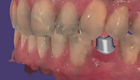 Implant Module