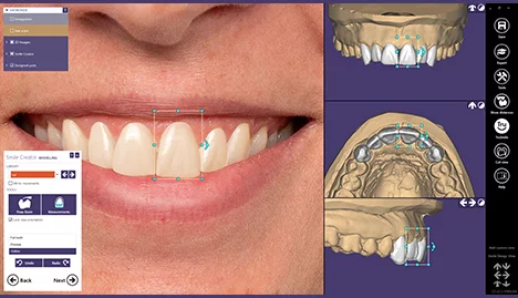 Smile Design