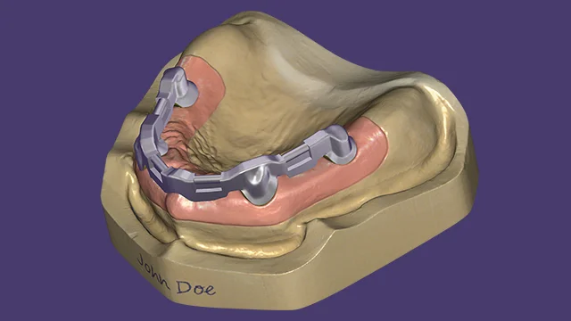 Screw retained bridges