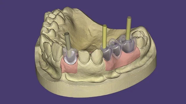 Custom Abutments
