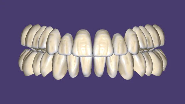 Temporary crowns and bridges