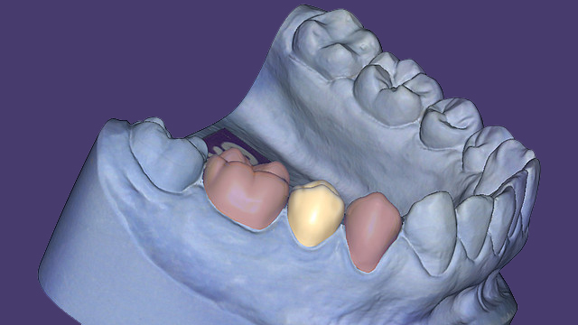 Temporary crowns and bridges