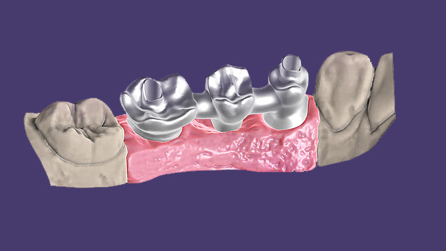 Screw-retained bridges