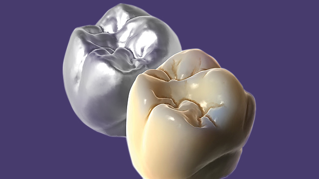 Realistic rendering of dental restorations in real-time